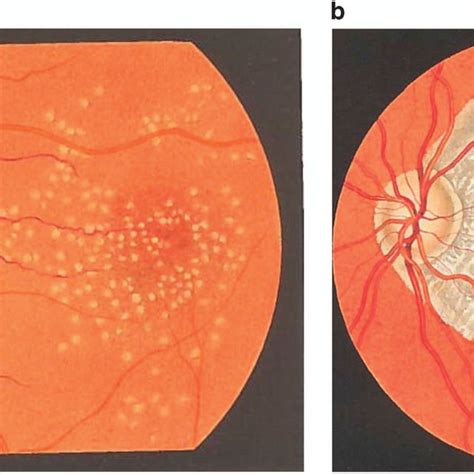 Elusive drusen and changing terminology of AMD .